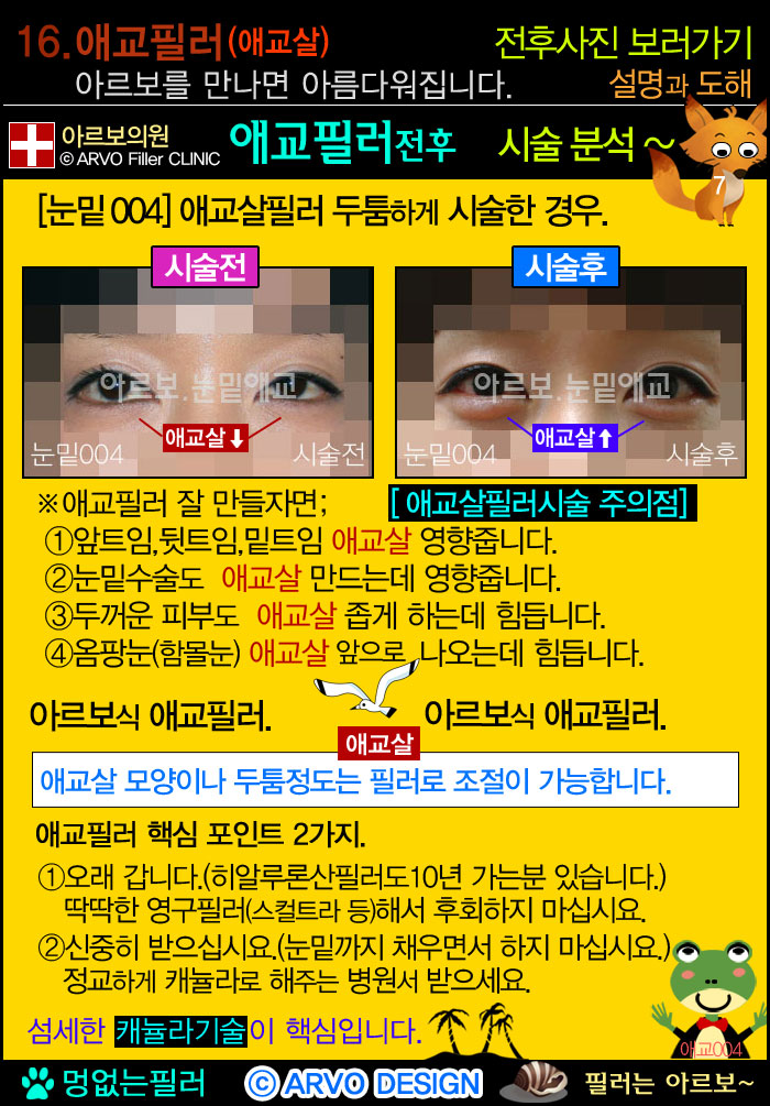 애교필러,애교살필러,눈밑필러,다크서클,다크써클,애교필러주의점2가지